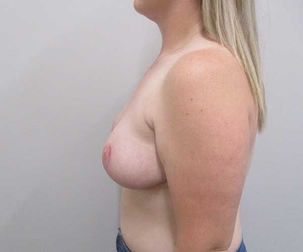 Breast Reduction Before & After