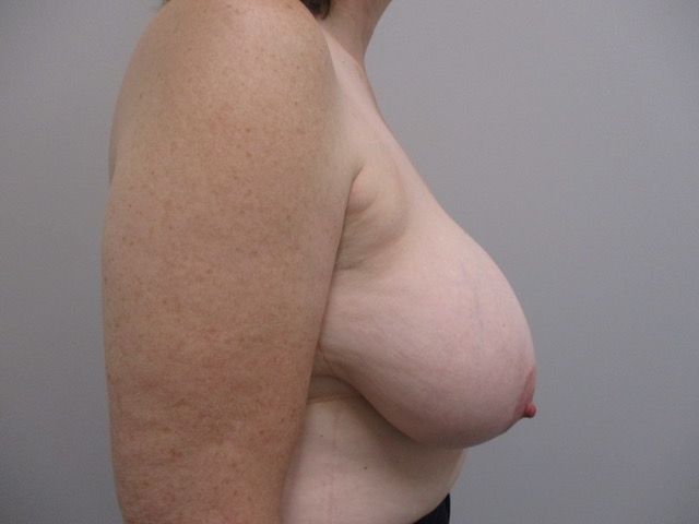 Breast Reduction Before & After