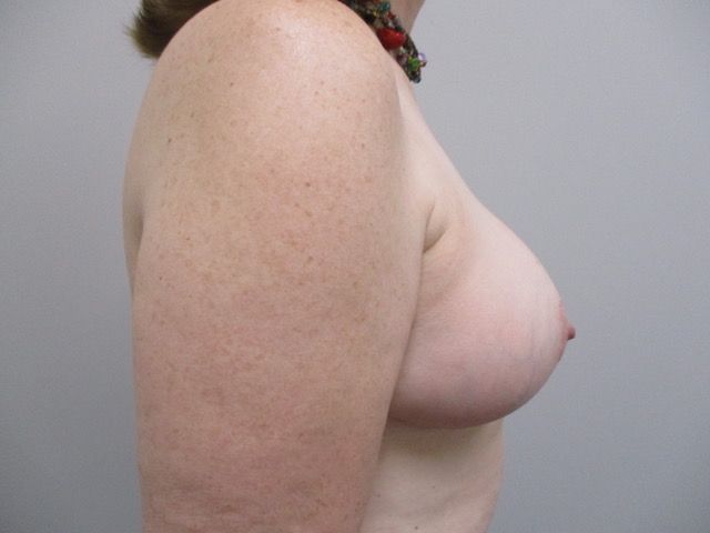 Breast Reduction Before & After