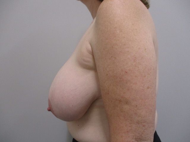 Breast Reduction Before & After
