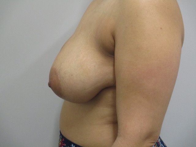 Breast Reduction Before & After