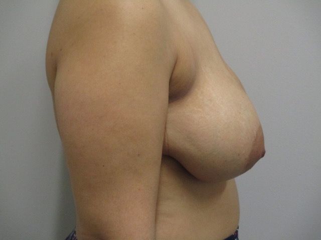 Breast Reduction Before & After