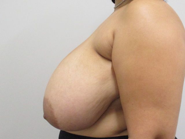 Breast Reduction Before & After