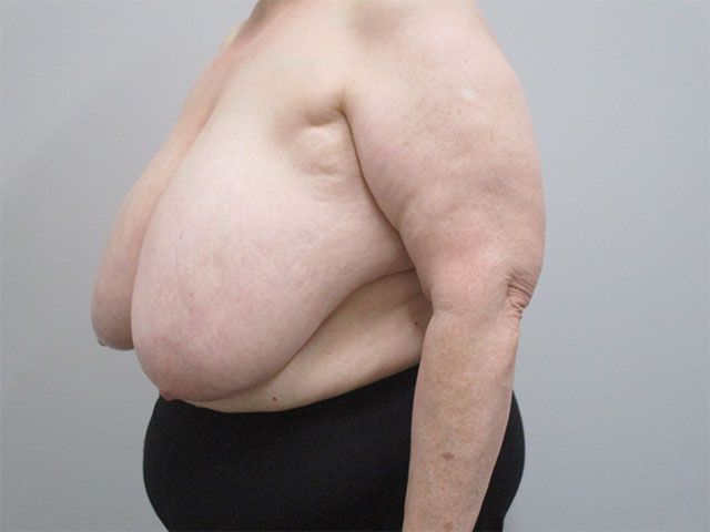 Breast Reduction Before & After