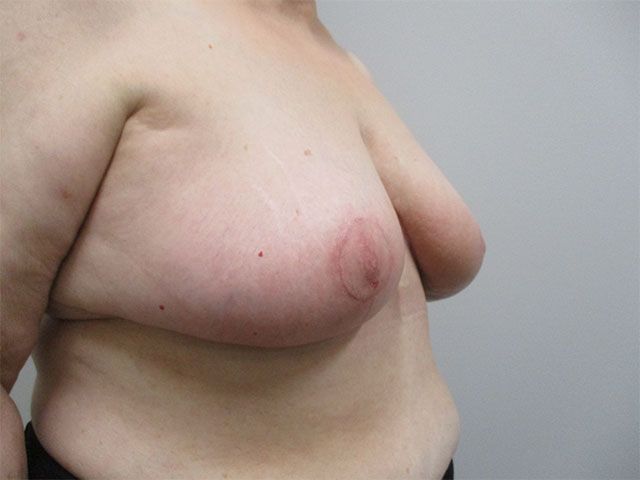 Breast Reduction Before & After