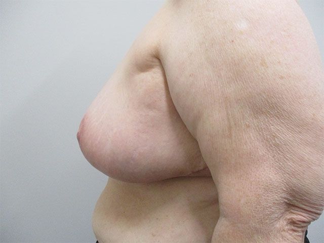 Breast Reduction Before & After