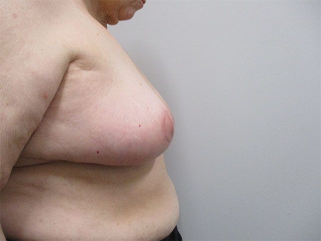 Breast Reduction Before & After