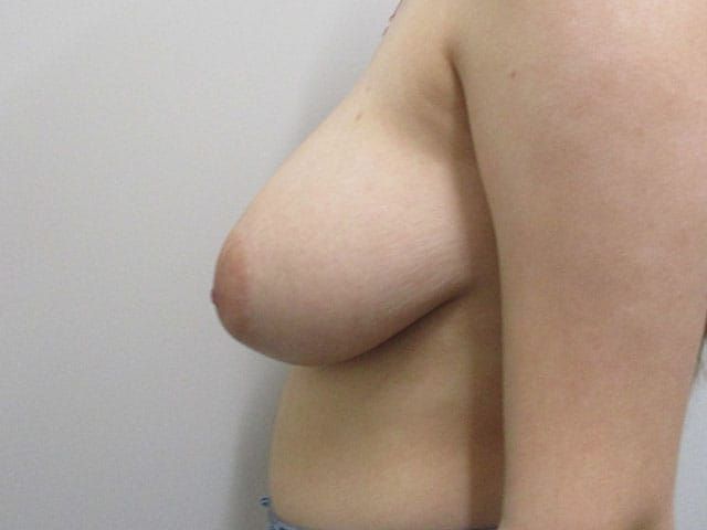 Breast Reduction Before & After