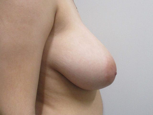 Breast Reduction Before & After