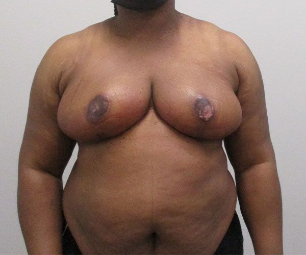 Breast Reduction Before & After