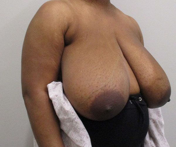 Breast Reduction Before & After