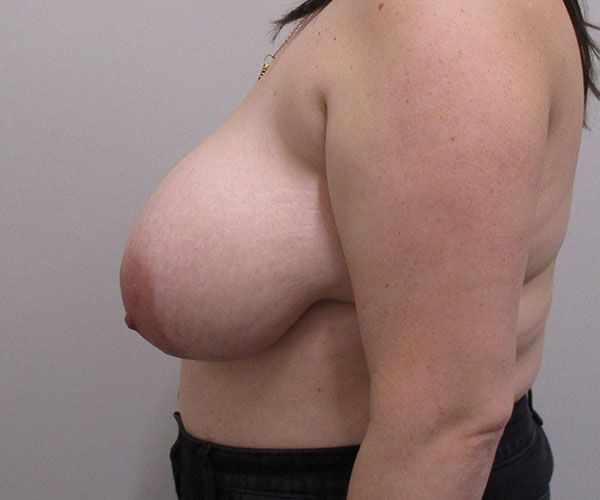 Breast Reduction Before & After