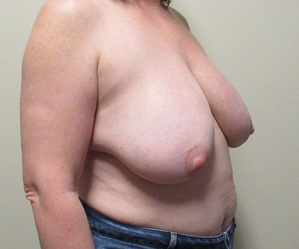 Breast Reduction Before & After