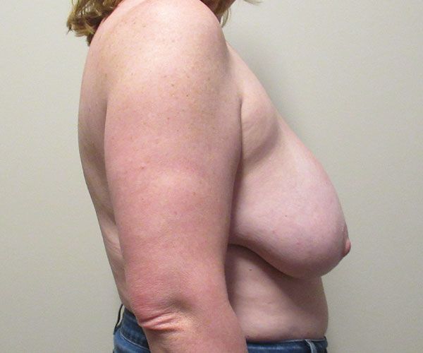 Breast Reduction Before & After