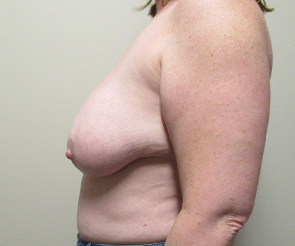 Breast Reduction Before & After