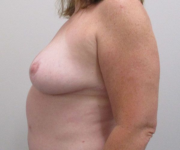 Breast Reduction Before & After