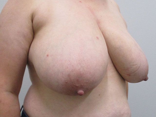 Breast Reduction Before & After