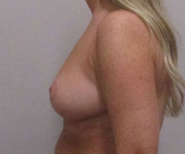 Breast Reduction Before & After