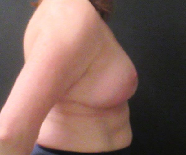 Breast Reduction Before & After