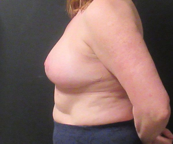 Breast Reduction Before & After