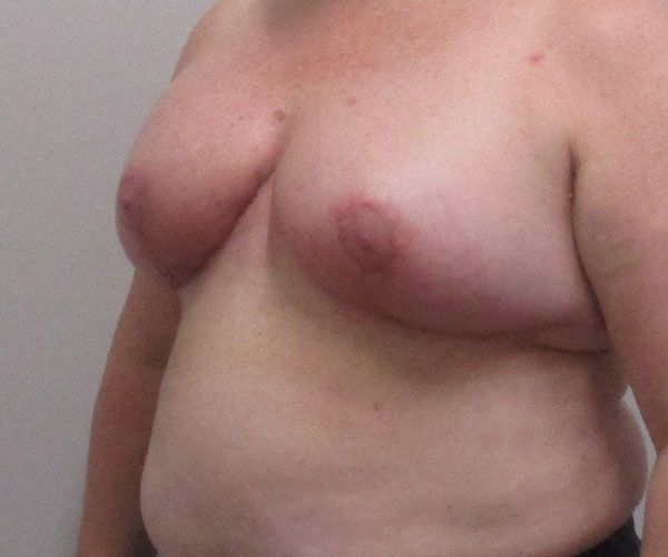 Breast Reduction Before & After