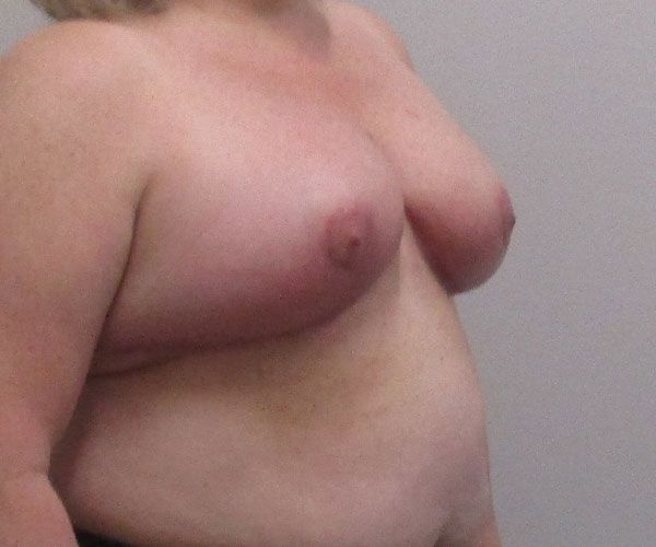 Breast Reduction Before & After