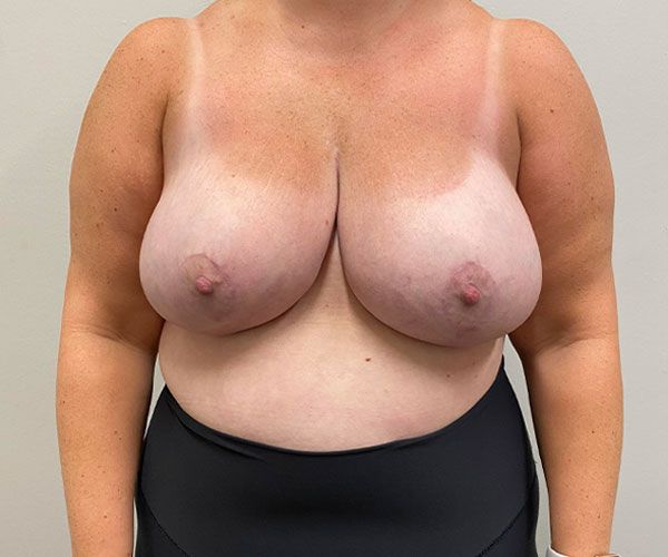 Breast Reduction Before & After