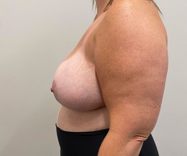 Breast Reduction Before & After