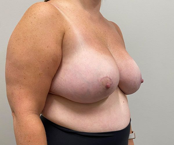 Breast Reduction Before & After