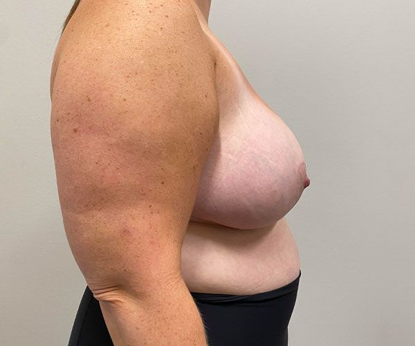 Breast Reduction Before & After