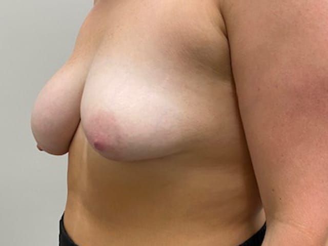 Breast Reduction Before & After