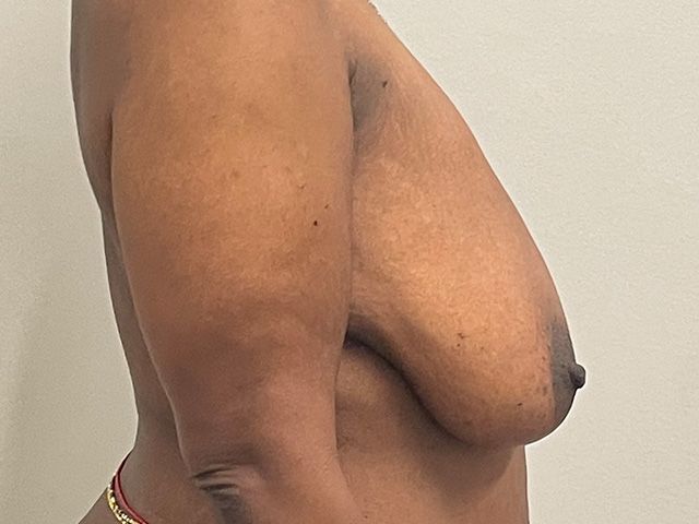 Breast Reduction Before & After