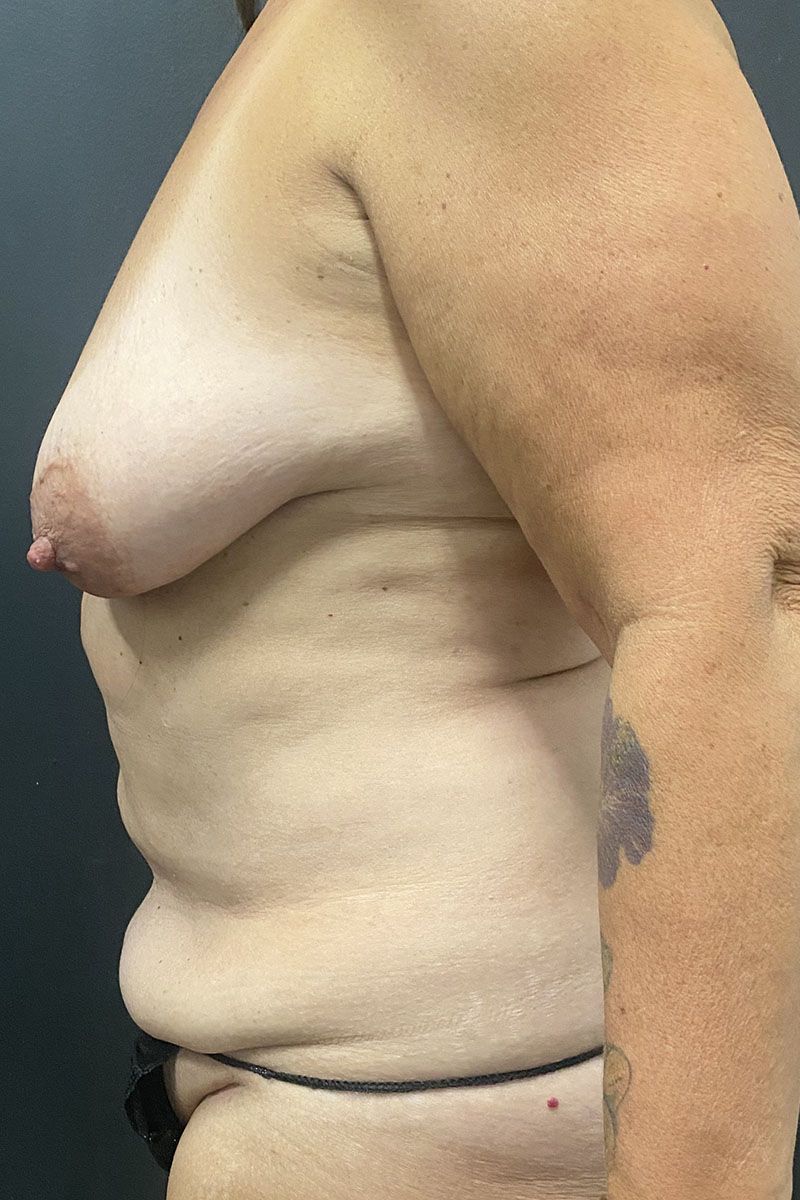 Mommy Makeover Before & After