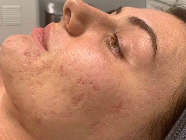 Microneedling Before & After