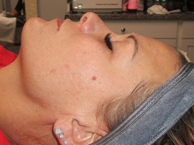 Microneedling Before & After