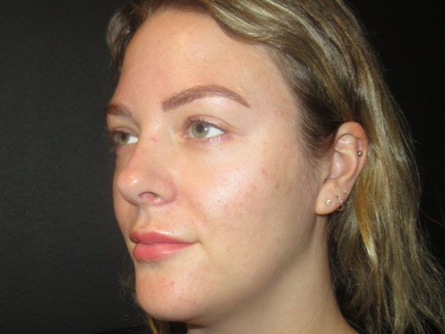 Microneedling Before & After