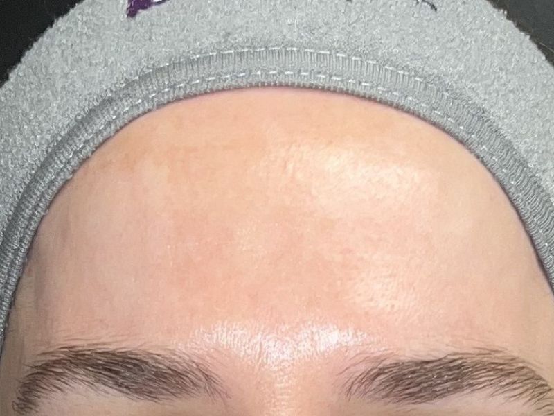 Microneedling with Exosomes Before & After