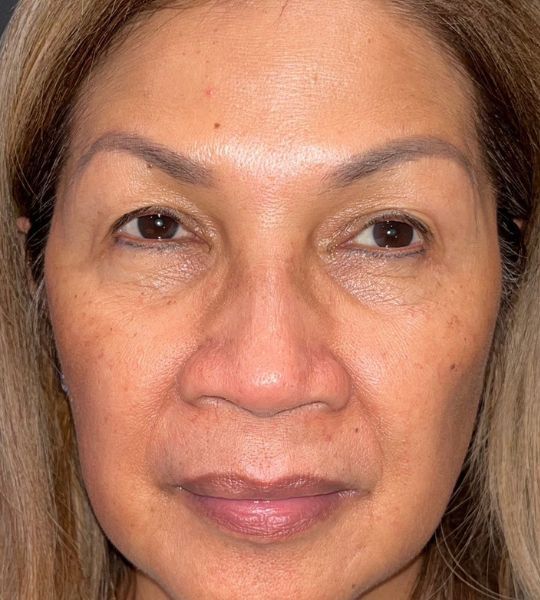 Microneedling with Exosomes Before & After