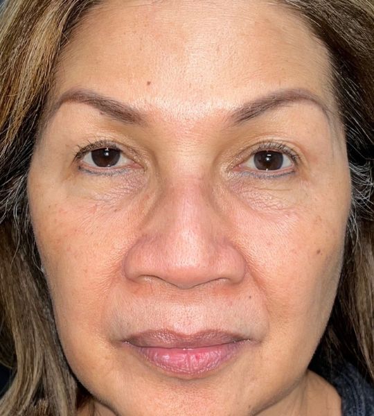Microneedling with Exosomes Before & After