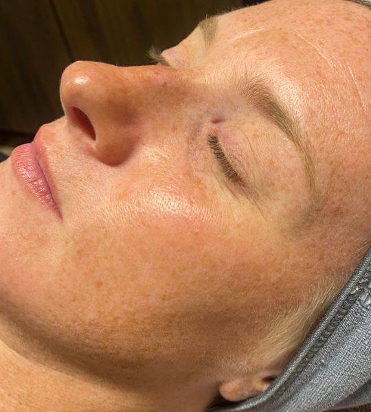 Microneedling with Exosomes Before & After