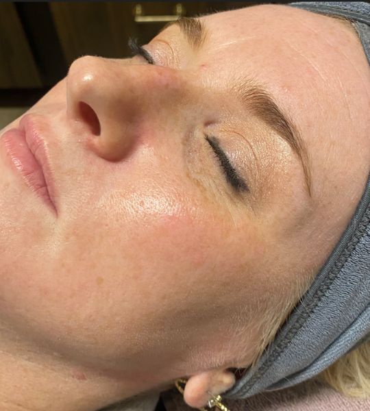 Microneedling with Exosomes Before & After