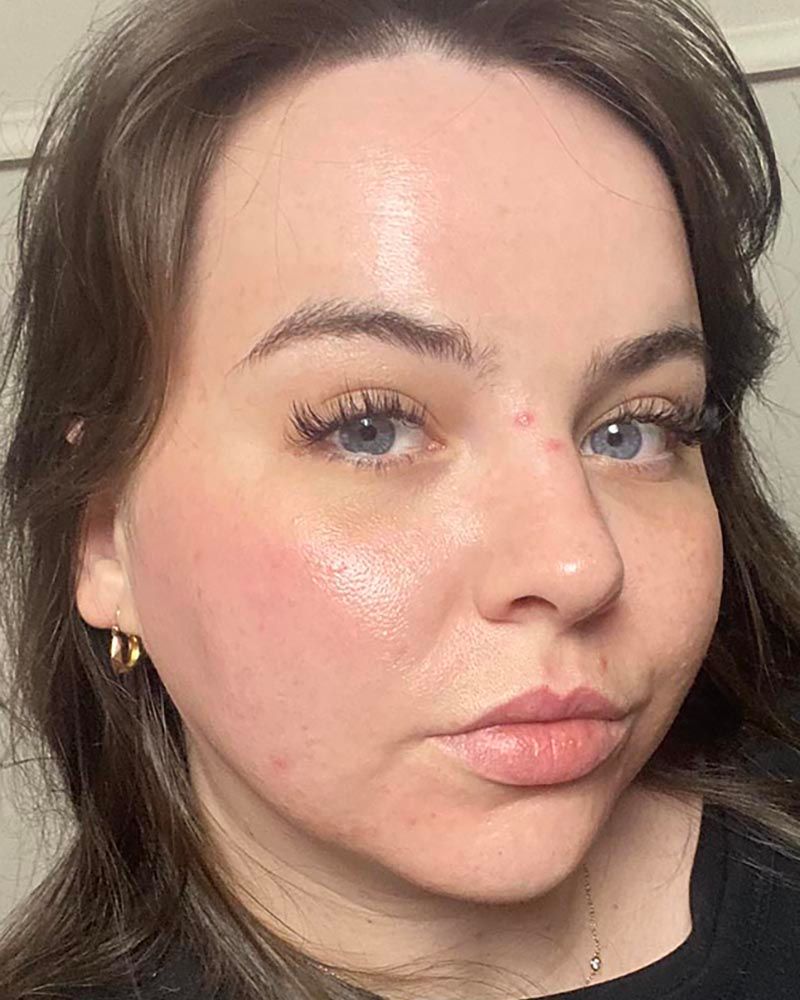 Microneedling with Exosomes Before & After