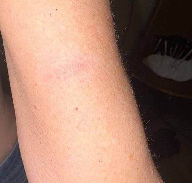 Microneedling with Exosomes Before & After