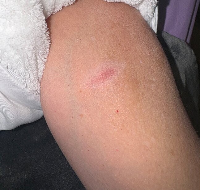 Microneedling with Exosomes Before & After