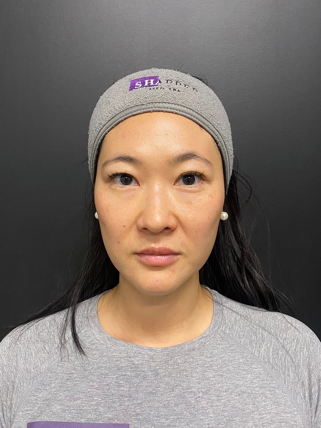 Microneedling with Exosomes Before & After