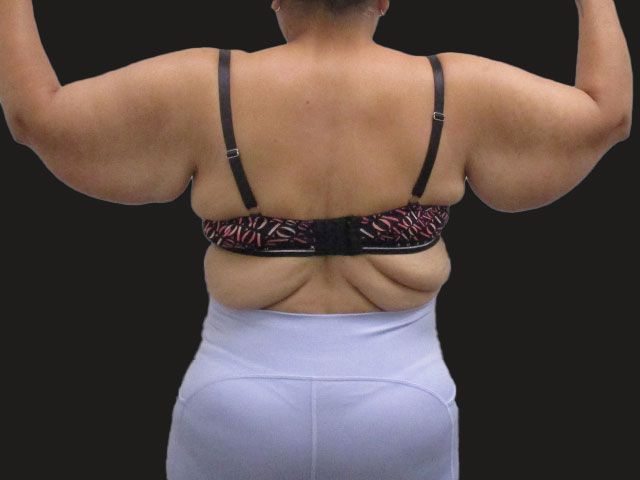 Brachioplasty Before & After