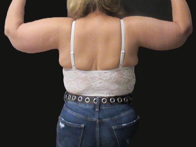 Brachioplasty Before & After