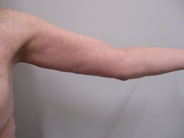 Brachioplasty Before & After