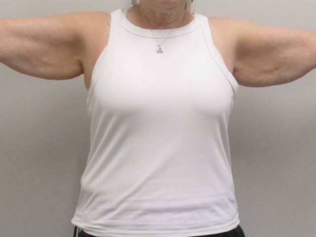 Brachioplasty Before & After