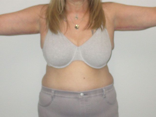 Brachioplasty Before & After